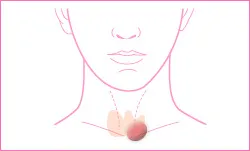 結節性甲状腺腫